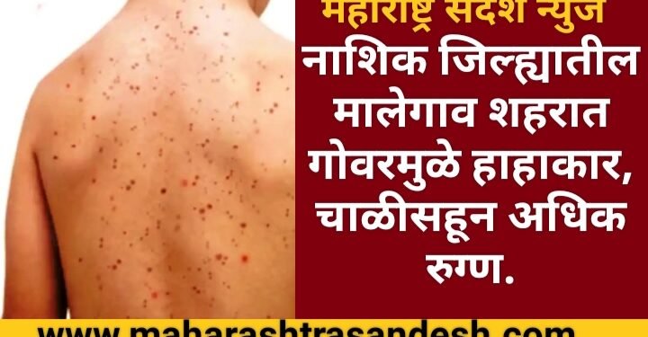 नाशिक जिल्ह्यातील मालेगाव शहरात गोवरने हाहाकार माजविल्या, आता पर्यंत चाळीसहून अधिक रुग्ण.