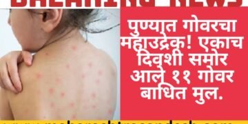 पुण्यात गोवरचा महाउद्रेक! एकाच दिवशी समोर आले 11 गोवर बाधित मुल.