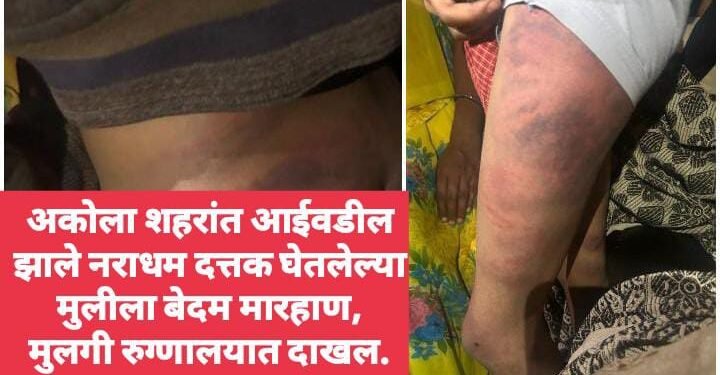 अकोला शहरांत दत्तक घेतलेल्या मुलीला आई वडिलांनी केली बेदम मारहाण, मुलगी रुग्णालयात दाखल.